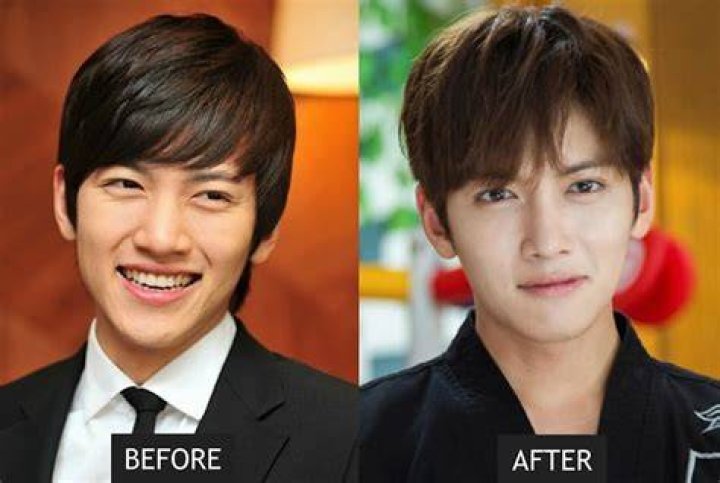 Korean Actors Plastic Surgery Before And After